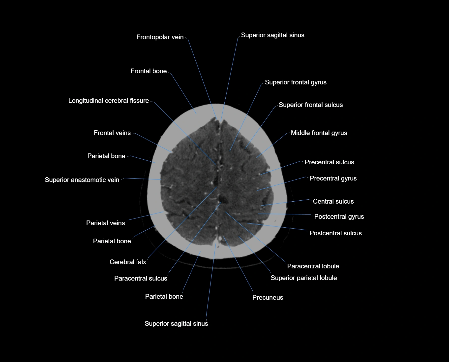 CT scan brain axial labelled cross sectional anatomy image-img-000060.webp